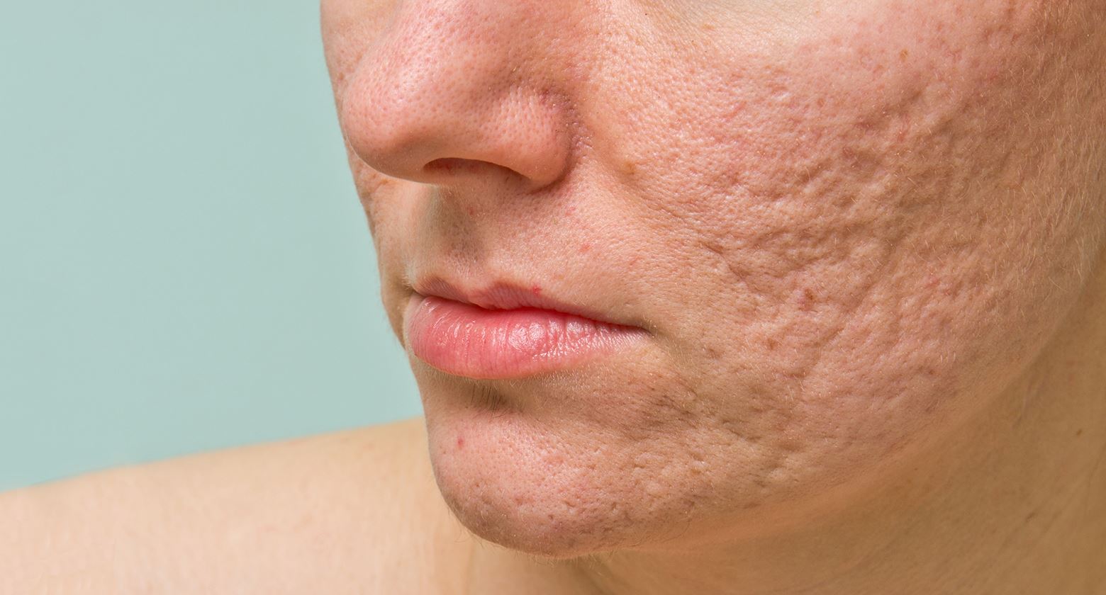 HOW TO GET RID OF ACNE AND SCARS Dr Health Clinic