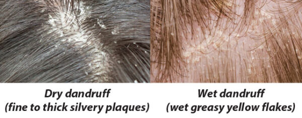 Dry Dandruff Vs Wet Dandruff Dr Health Clinic Homepage