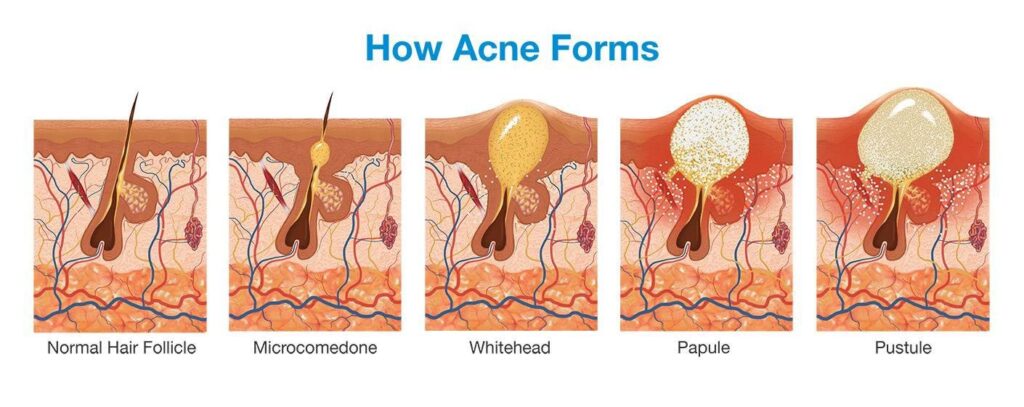 how-acne-forms-dr-health-clinic-homepage