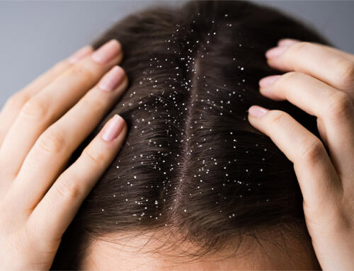 Winter Dandruff Woes: Why It Gets Worse and How to Manage It